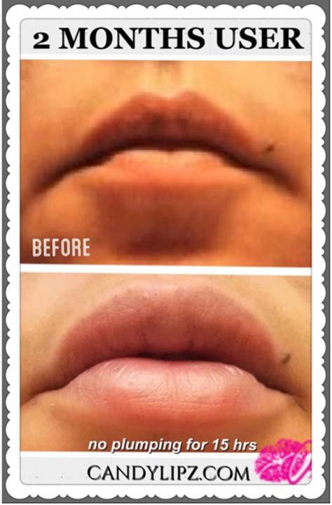 How to Reduce Drooping Mouth Corners - CandyLipz