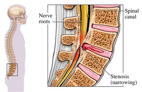 Spinal Stenosis Definition, Causes, Symptoms and Treatment - Expert ...