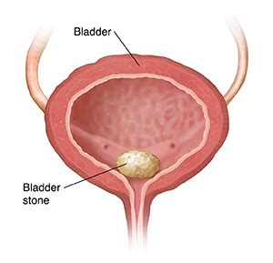 Cystolitholapaxy (Bladder Stone Surgery): Procedure & Recovery