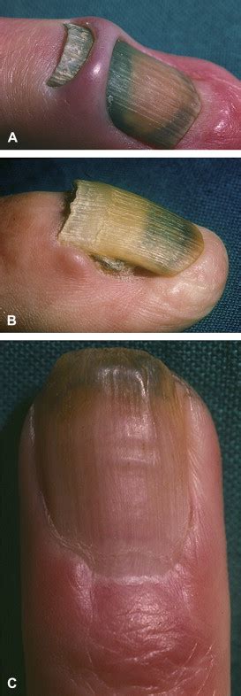 Retronychia: Proximal ingrowing of the nail plate - Journal of the American Academy of Dermatology