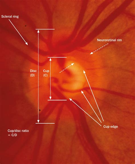 grosor Crueldad Productividad optic nerve head glaucoma construir orar Pórtico