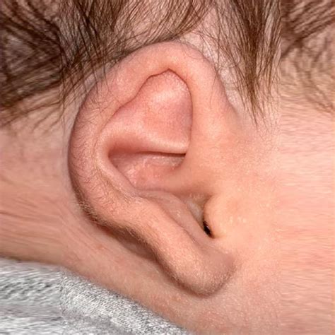 Types of Ear Deformities - Dr. Onganlar - Infant Ear Molding