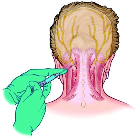 Greater Occipital Nerve Block for Acute Treatment of Migraine Headache: A Large Retrospective ...