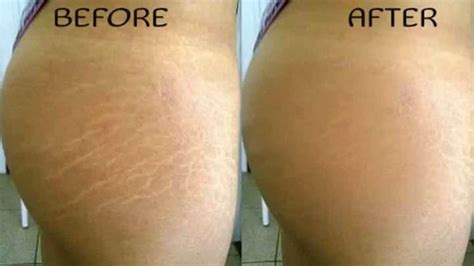 How to Get Rid of Old Stretch Marks with Ease