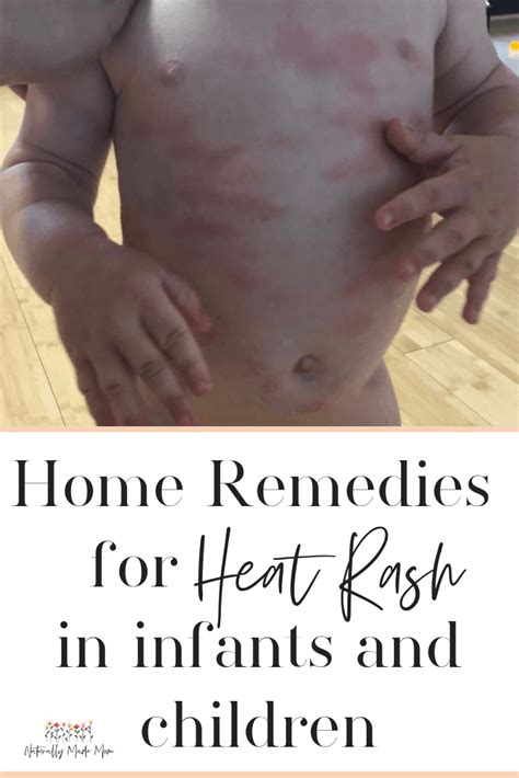 5 Effective Home Remedies for Baby Heat Rash | Heat rash, Baby heat rash, Heat rash remedy