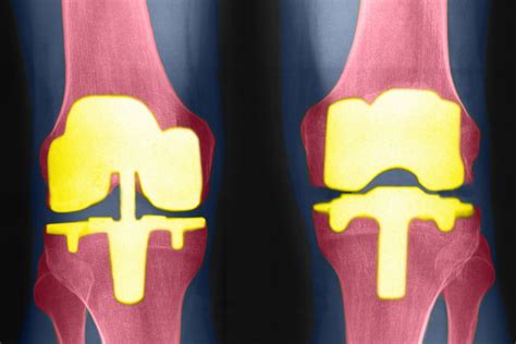 Types of Bilateral Knee Replacement