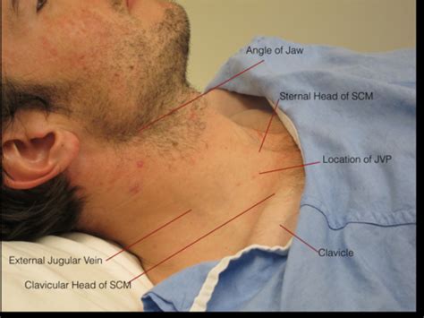 Jugular Venous Pulse Flashcards | Quizlet