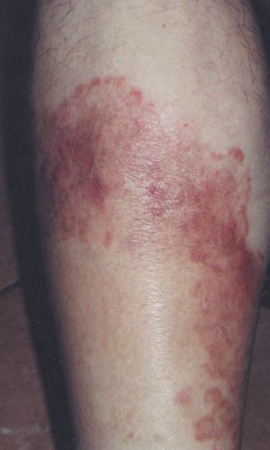 Diabetic Man With Pruritic Pretibial Rash | Consultant360