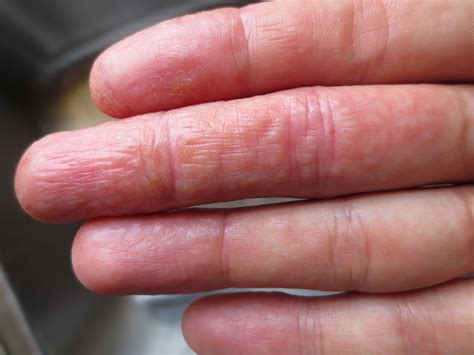 Dermatitis Rash On Hands