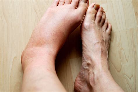 4 Symptoms of Venous Disease - The Vein Center of Cincinnati, LLC