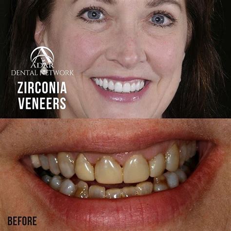 Before and After SOLID Zirconia Veneer Work By Adar! . . #AdarDentalNetwork #PinhasAdar #Adar # ...