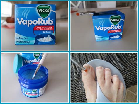 Effective Types of Toe Fungus Treatment