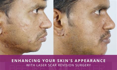 Laser Scar Revision Surgery : Enhancing Your Skin’s Appearance – Richardson's Plastic Surgery ...