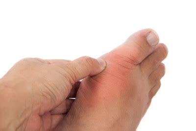 Sprained Toe Diagnosis and Treatment | Minnetonka Foot Care