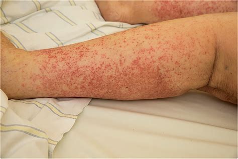 The rash that becomes purpuric, petechial, hemorrhagic, or ecchymotic - Clinics in Dermatology