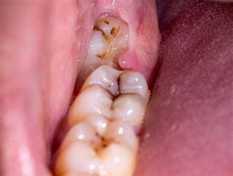 ถอนฟันกราม เจ็บหรือไม่ หลังถอนฟันมีวิธีการดูแลตนเองอย่างไร