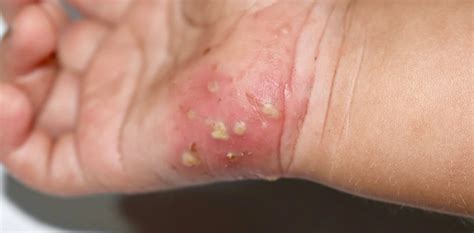 Scabies: UK facing unusually large outbreaks – and treatment shortages ...