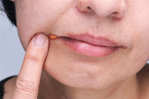 Angular Cheilitis Vitamin Deficiency - Angular Cheilitis Causes