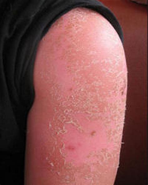 Sunburn Home Remedies