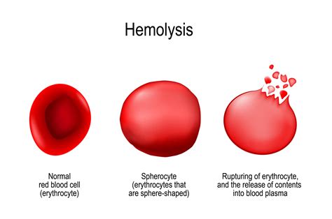 What are the Causes of Anemia? - Drug Genius