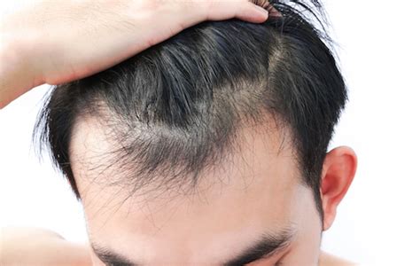 6 Hair Loss Treatments You Can Do at Home - Psyco Health