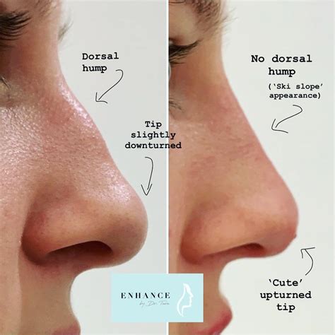 Nose enhancement to camouflage the dorsal hump 👃🏽 | Rhinoplasty nose jobs, Nonsurgical nose job ...