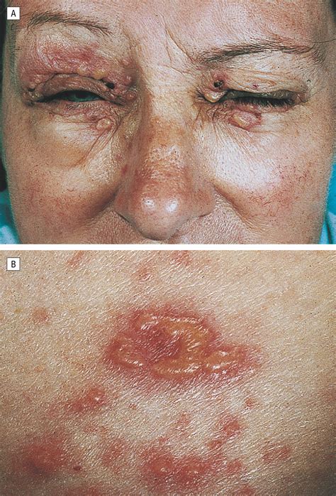 Epidermolysis Bullosa Acquisita Histology