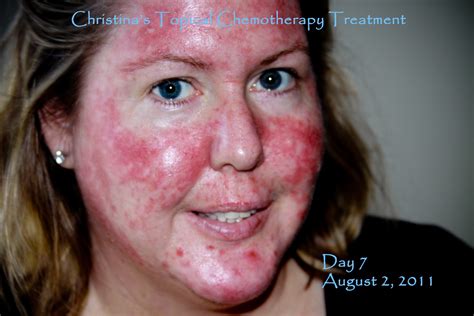 Chemo Rash On Face