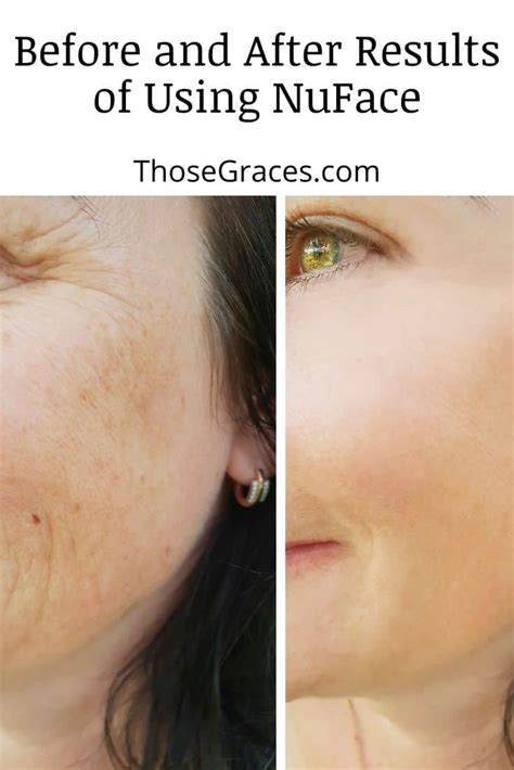 Nuface Toning Device: Before & After Results of Using - ThoseGraces.com