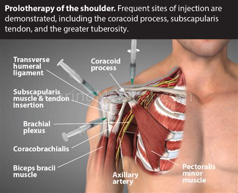 Treatment options for Failed Rotator Cuff Surgery