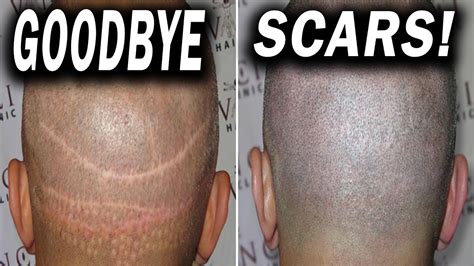 How To Get Rid of Scars after FUE or FUT Hair Transplant - YouTube