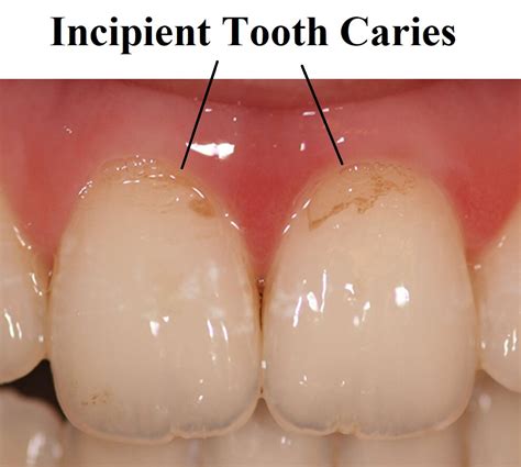 What is incipient caries? | News | Dentagama