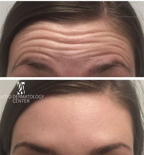 Botox Forehead - Lloyd Dermatology Center