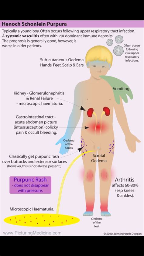 Henoch Schonlein Purpura. A classic pattern of disease as shown in the ...