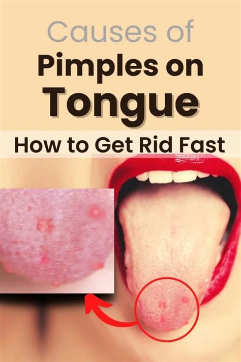 Pimples on Tongue? Lie Bumps Tongue, Causes, Get Rid of it - MG