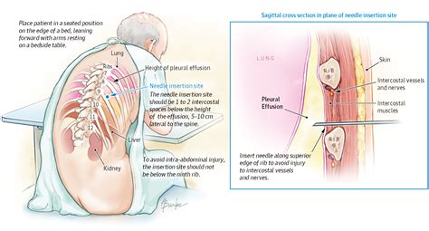 Does This Patient Have an Exudative Pleural Effusion?The Rational Clinical Examination ...