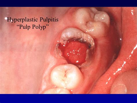 dental polyp – Liberal Dictionary