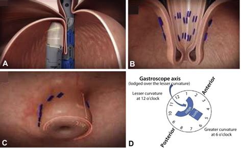 Endoscopic GERD therapy: a primer for the transoral incisionless fundoplication procedure ...