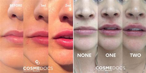 Lip Filler Shapes Chart - Infoupdate.org