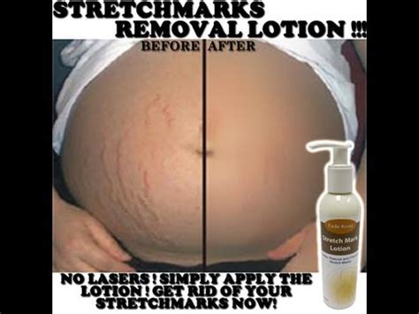 Stretch Mark Cream: Before and After Product Reviews - YouTube