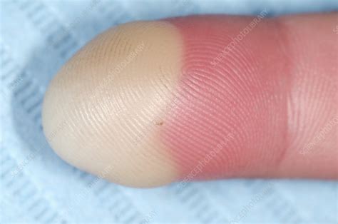 Paronychia infection of the finger - Stock Image - C016/8167 - Science Photo Library