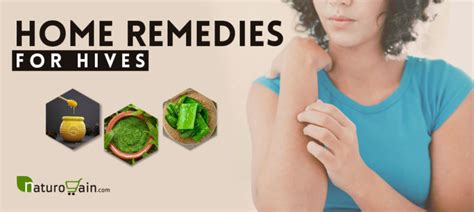 8 Best Home Remedies for Hives to Relieve Itching [Naturally]