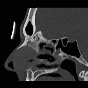 Foramen cecum | Radiology Reference Article | Radiopaedia.org