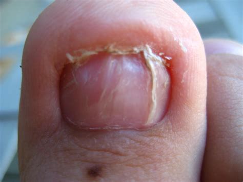 Do You Have A Dead Toenail? - Podiatry HQ Clinics