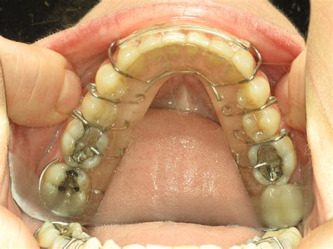 Orthodontist Dr. Judith A. Okun - Westchester and Rye Brook, NY: Bonded (Permanent) Retainers ...