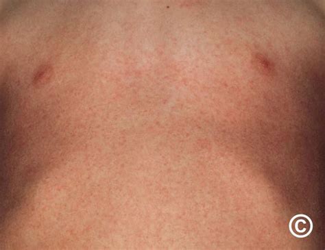 212+ Images Of Viral Rashes - MyWeb