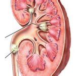 Urinary Tract Stones | Symptoms and Treatment of Kidney Stone