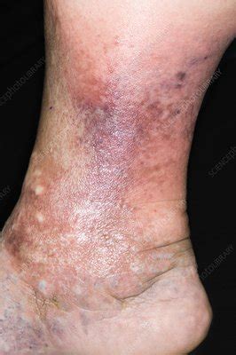 Cellulitis of the leg - Stock Image - C001/6610 - Science Photo Library