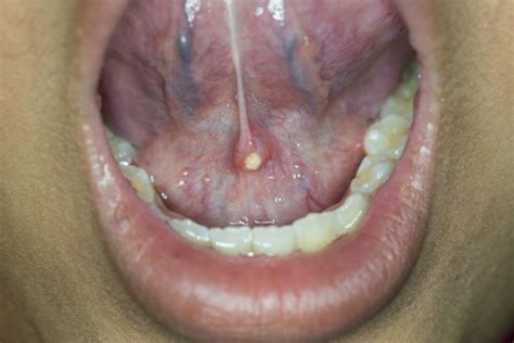 Salivary gland stones/Sialolithiasis | ENT Surgeon