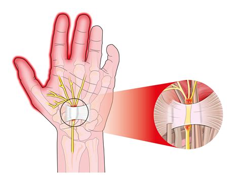 Carpal Tunnel Syndrome | The Pain Relief Clinic